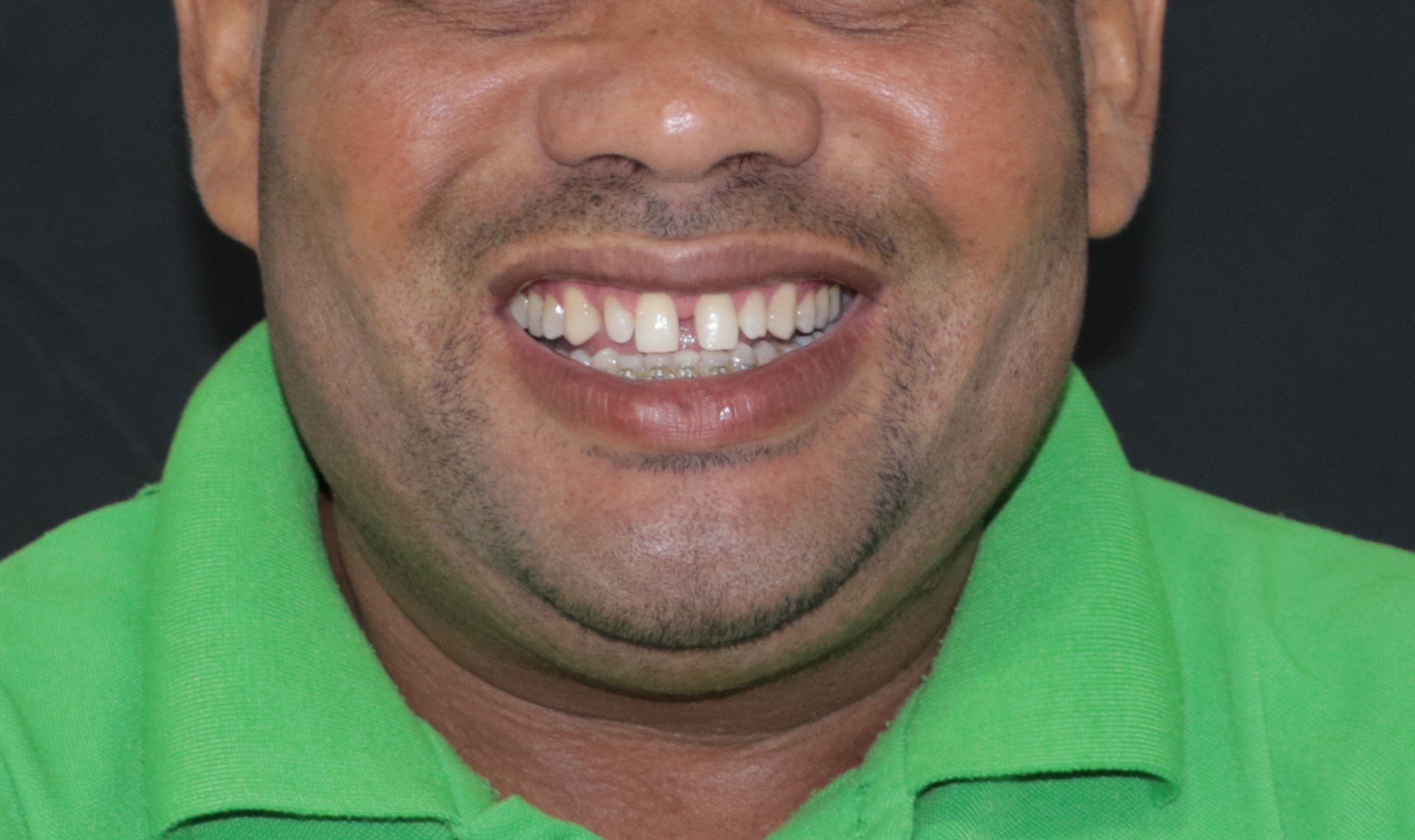 Antes