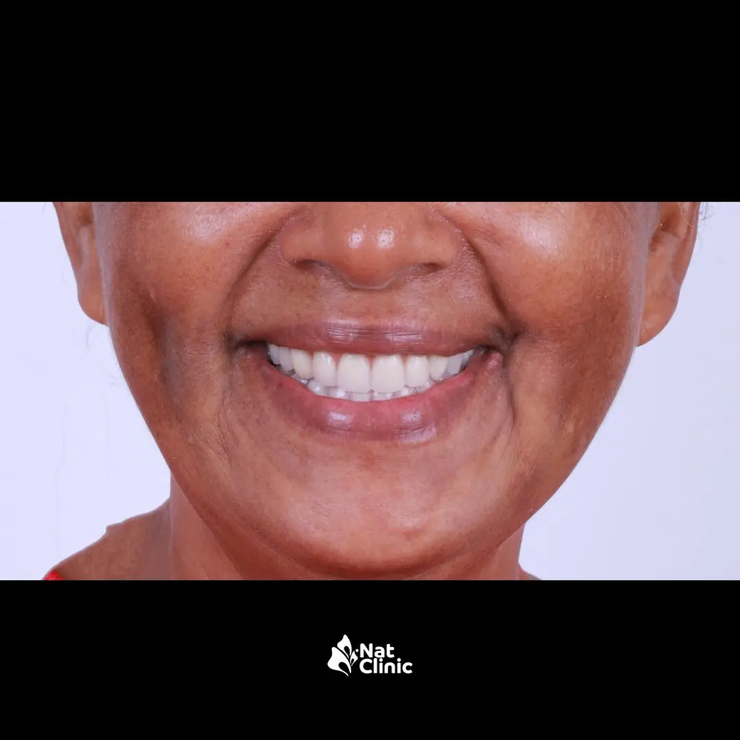 Transformación de sonrisa - Después
