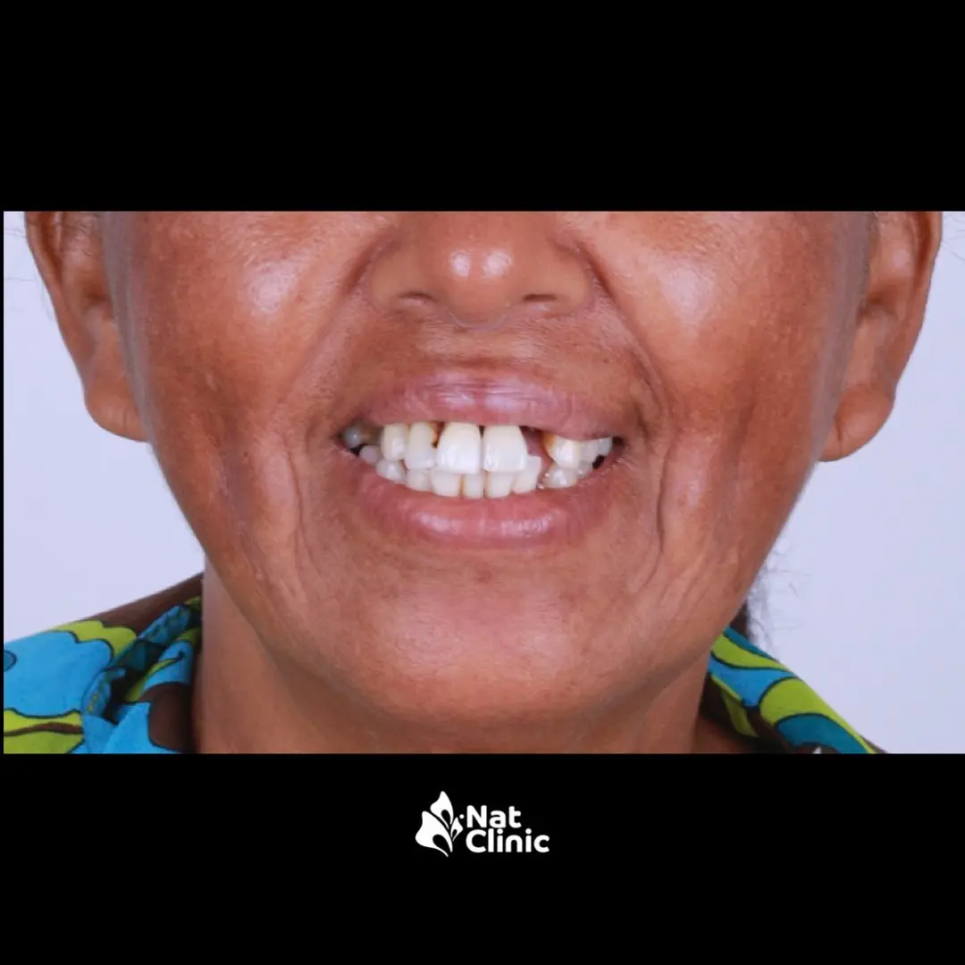 Transformación de sonrisa - Antes